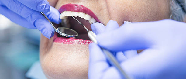Best Knocked-Out Tooth (Avulsed Tooth) Treatment in Langley, SC